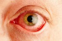 Kentut Bisa Bikin Mata Merah, Apakah Benar?