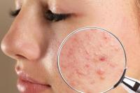 Ternyata, Konsumsi Gorengan Selama Ramadan Dapat Memicu Jerawat