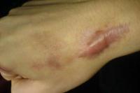 Cara Menghilangkan Bekas Lupa, Ada Yang Bisa Pake Sunscreen