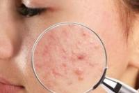 Begini Cara Hilangkan Bruntusan di Rumah