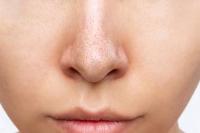 Berikut Tiga Bahan Alami untuk Hilangkan Komedo