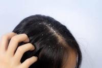 Benarkah Masalah Ketombe Bisa Diselesaikan dengan Shampo?