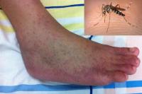 Jangan Tunggu Terinfeksi Ini Tips Cegah Chikungunya