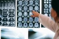 Ilmuwan Temukan "Saklar Tersembunyi" di Otak yang Mengatur Risiko Alzheimer