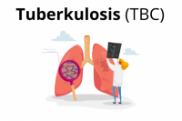 Mengapa Penderita TBC Cenderung Kurus, Berat Badan Turun Drastis?