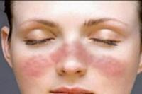 Lupus, Penyakit Seribu Wajah yang Belum Ada Obatnya