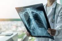 Gejala Kanker Paru Bisa Terlihat di Kuku, Ini Tandanya