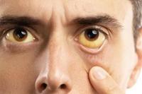 Alis Sebelah Kiri Berkedut, Ini Kata Medis