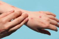 Langka! Perempuan Ini Alami Alergi Air, Kulit Terkena Air Muncul Biduran