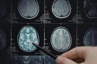 Waspada, Infeksi Pernapasan Bisa Berujung Penyakit Alzheimer