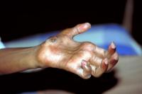 7 Mitos dan Fakta Penyakit Kusta yang Harus Diluruskan