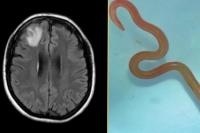 Untuk Pertama Kalinya, Parasit Ular Ditemukan Hidup di Otak Manusia