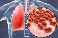 5 Gejala Infeksi Paru-Paru yang Sering Dianggap Flu Biasa